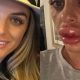 England bans lip filler and Botox
