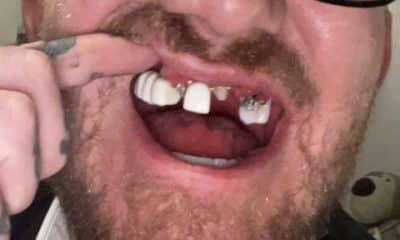 Man spent 80k fixing his dentition after cocaine abuse and horror operations left his teeth falling out